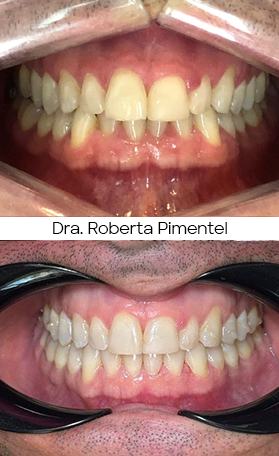 Resultado Invisalign — antes e depois