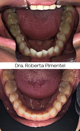 Resultado Invisalign — antes e depois