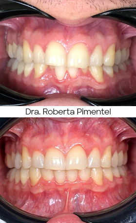 Resultado Invisalign — antes e depois