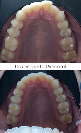 Resultado Invisalign — antes e depois