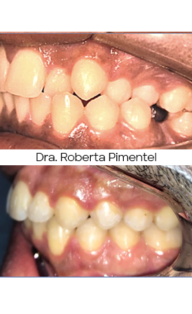 Resultado Invisalign — antes e depois