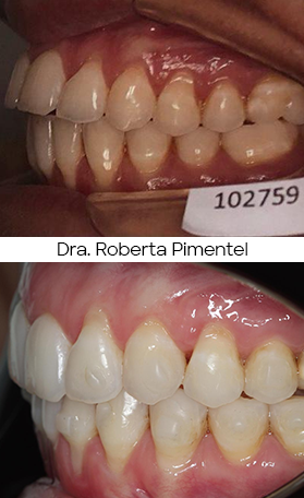 Resultado Invisalign — antes e depois