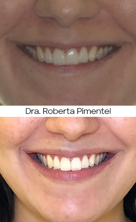 Resultado Invisalign — antes e depois