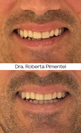 Resultado Invisalign — antes e depois