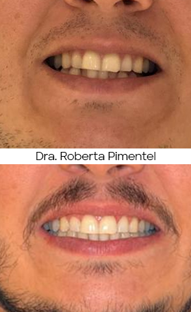 Resultado Invisalign — antes e depois