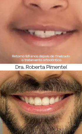 Resultado Invisalign — antes e depois