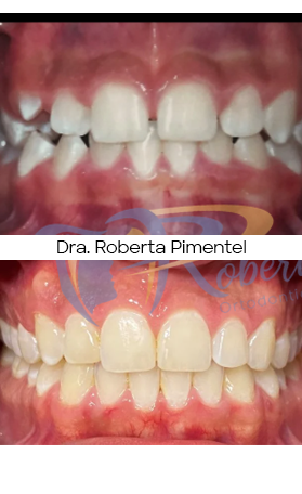 Resultado Invisalign — antes e depois