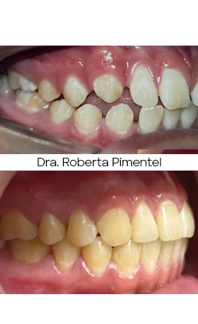 Resultado Invisalign — antes e depois