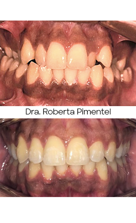 Resultado Invisalign — antes e depois