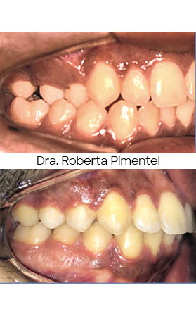 Resultado Invisalign — antes e depois