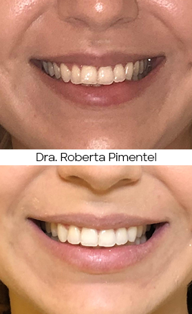 Resultado Invisalign — antes e depois